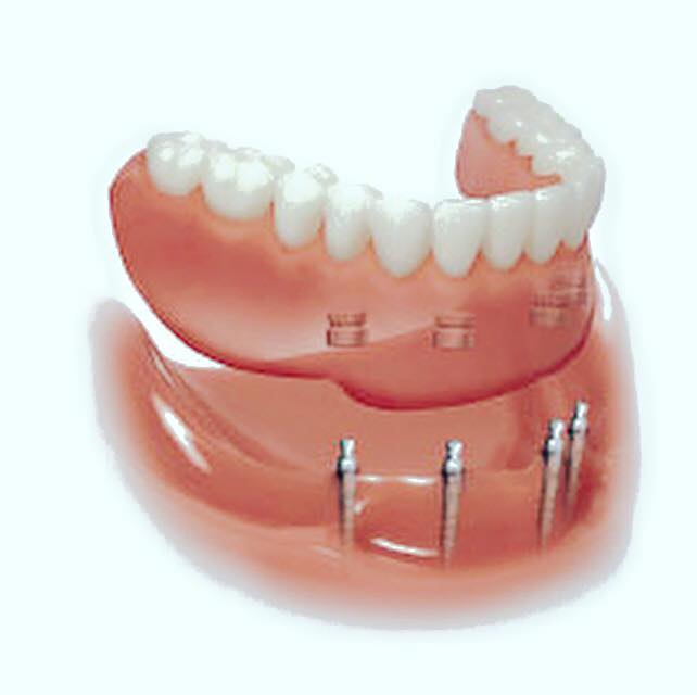 Snap on Dentures JACKSONVILLE, FL Carlos J Santiago , D.D.S.